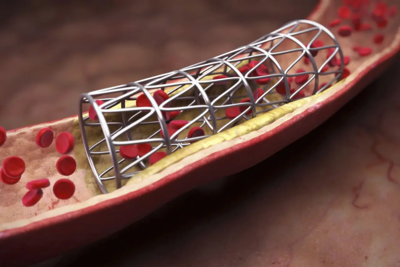 Stent Nedir?